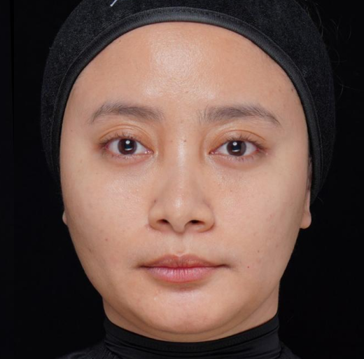 Before/After Image